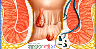 পাইলস বা অর্শ চিকিৎসায় হোমিও প্রতিবিধান