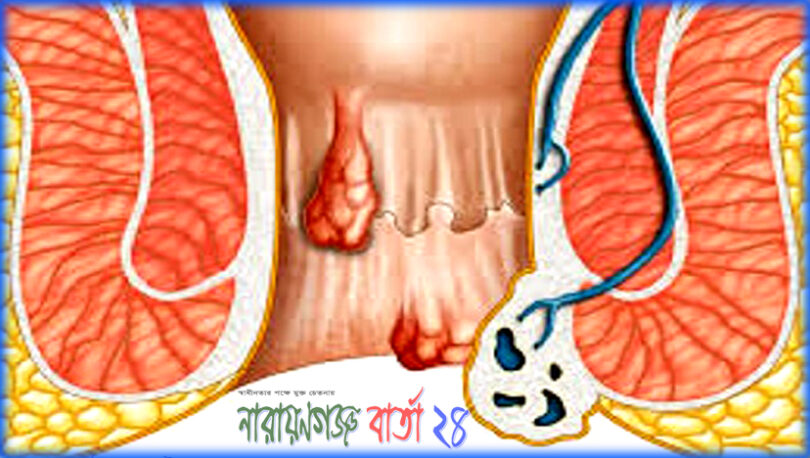 পাইলস বা অর্শ চিকিৎসায় হোমিও প্রতিবিধান