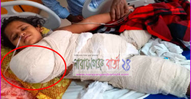 পূর্বাচল জোনাল অফিসের গাফিলতিতে বিদ্যুৎস্পৃষ্টে হাত হারালো শিশু মীম