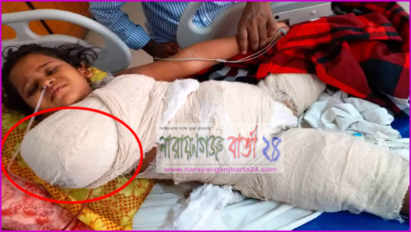 পূর্বাচল জোনাল অফিসের গাফিলতিতে বিদ্যুৎস্পৃষ্টে হাত হারালো শিশু মীম